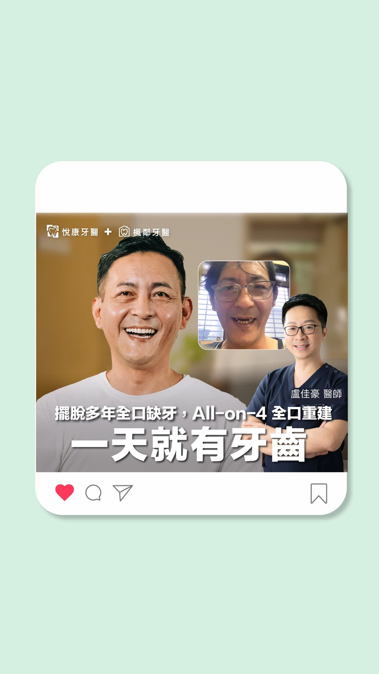 身為飄霧眉師及麻醉護理師，也是牙科闆娘的我🤭

來為大家介紹📝
🌟唯一  可以一天治療半口或全口缺牙或無牙的方法
🌟僅有  盧院長全數位化ALL-ON-4辦的到

深受牙周病困擾林先生，造成牙龈嚴重萎縮，多顆牙齒脫落，只剩幾顆牙齒可以咀嚼，嚴重造成進食困難。
為了改善嚴重缺牙問題，尋找許多假牙製作及植牙診所，後來找到盧醫師，使用最新技術#Allon4一日全口重建，ㄧ覺醒來擁有一口健康好牙，恢復以往自信，也一直被稱讚變年輕。以前喜歡吃海鮮無法好好的吃，現在連螃蟹都可以不用顧慮大口享受。

🔎誰適合做All-on-4一日全口重建
✅適合全口無牙、多顆缺牙
✅全口龋齒嚴重
✅需要重建咬合
✅牙龈萎縮嚴重
✅患有活動假牙症候群

🦷 All-on-4 一日全口重建優點
#上午植牙下午即有牙：當天手術、當天装牙，超快速。
#高科技導航儀器：全程使用植牙導航機，手術精準安全又快速。
#世界級植體：採用世界級品牌「諾保科Nobel Biocare植體」。
#舒眠搭配手術：一覺醒來就有牙齒。
#不用頻繁回診：減少舟車勞頓心理負擔。

💡選擇一日全口重建All-on-4/All-on-6
盧佳豪院長領軍專業團隊，以高難度技術，完美解決缺牙問題，舒眠無痛植牙，睡醒來即刻有牙，採用微創植牙的技術加導航定位植牙更精準更穩定!

📍了解更多All-on-4一日全口重建
https://bit.ly/4atbyo6

#有問題都可以私訊我唷
#我會請院長幫忙解惑😆